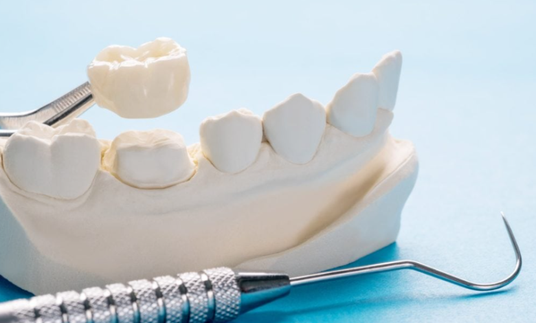 The Price of Restoration: What Dental Crowns Reveal About Our Relationship with Self-Care