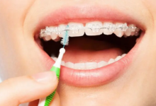 Smile Makeovers in Thornton: Braces or Invisalign?