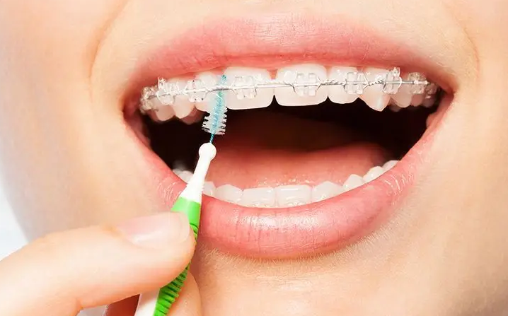 Smile Makeovers in Thornton: Braces or Invisalign?