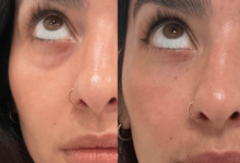 PRP Facial San Diego | Platelet Rich Plasma for Fine Lines Under Eyes
