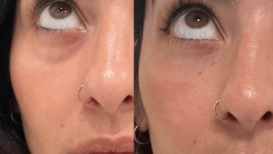 PRP Facial San Diego | Platelet Rich Plasma for Fine Lines Under Eyes