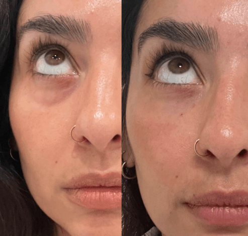 PRP Facial San Diego | Platelet Rich Plasma for Fine Lines Under Eyes